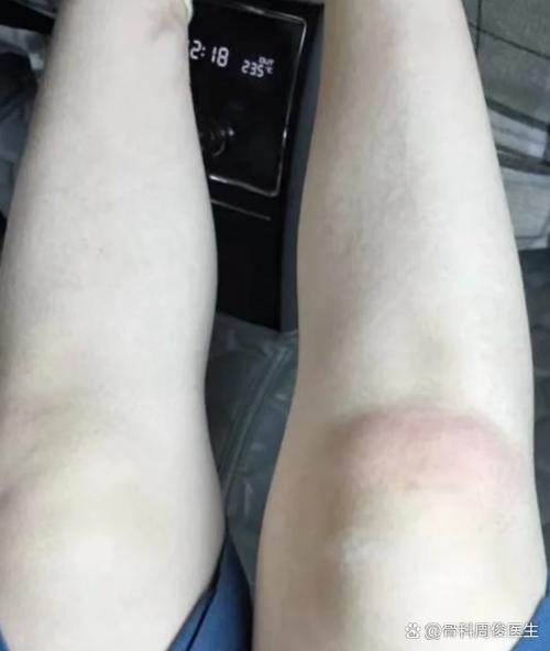 噩梦！穆迪刚复出就受伤，膝盖骨头突出，看着就吓人！